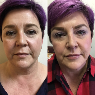 Radiesse before and after photo