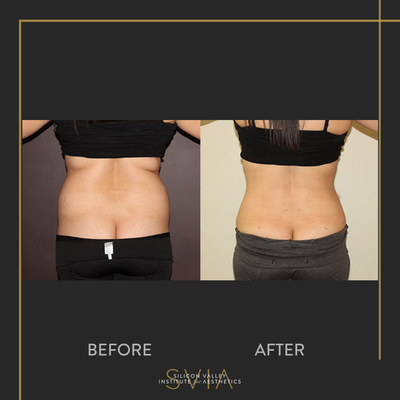 Liposuction before and after photo