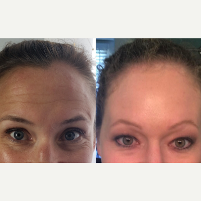 Liquid Facelift before and after photo