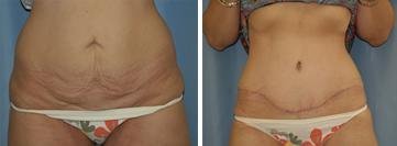 Tummy Tuck before and after photo