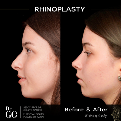 Rhinoplasty before and after photo