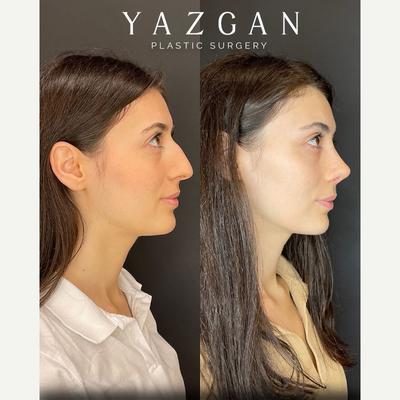 Rhinoplasty before and after photo