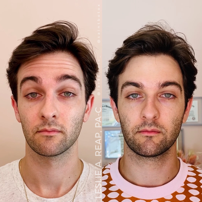 Dysport before and after photo