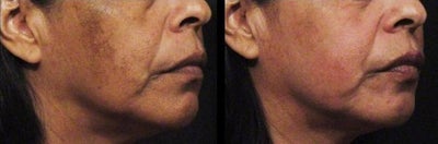 Cosmelan before and after photo