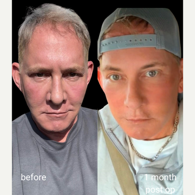 Facial Fat Transfer before and after photo