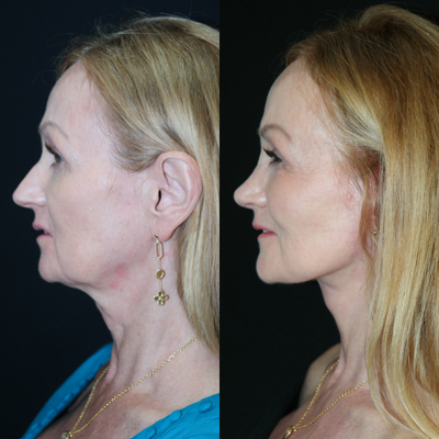 Lower Facelift before and after photo