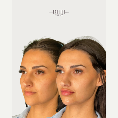 Chin Filler before and after photo