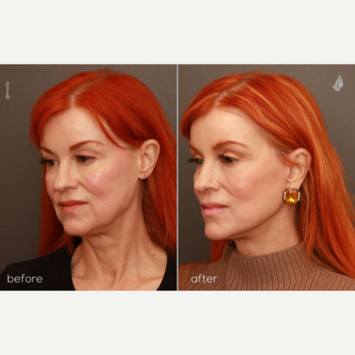 Facelift before and after photo