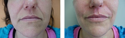 Lip Fillers before and after photo