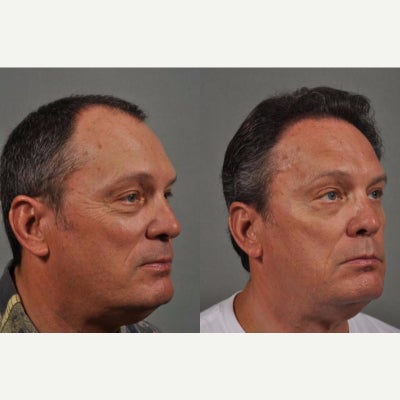 FUE Hair Transplant before and after photo