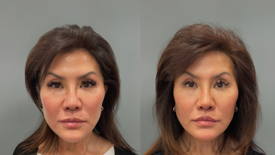 Lip Lift before and after photo