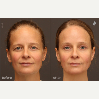 Brow Lift before and after photo