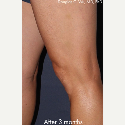 Sclerotherapy Treatment, Recovery, and Side Effects