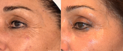 Skin Rejuvenation before and after photo