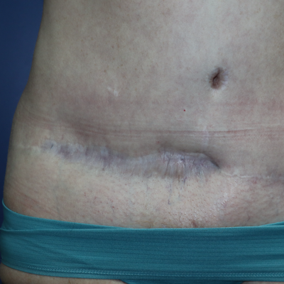 Are Tummy Tuck Revision Results Worth the Cost?