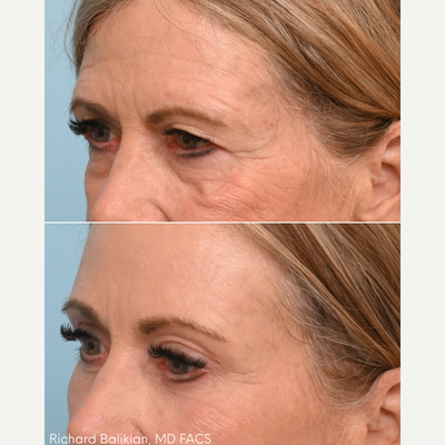 Facial Fat Transfer before and after photo