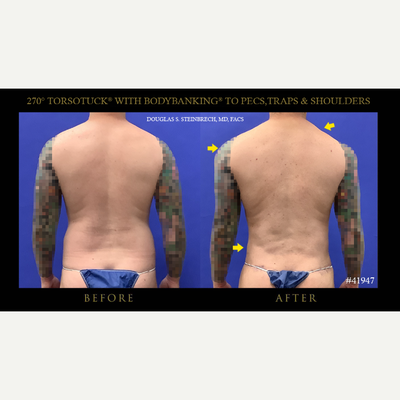 Body Lift before and after photo