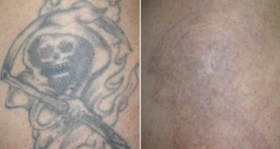 Tattoo Removal before and after photo