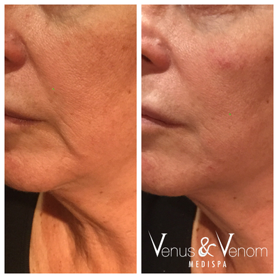 Juvederm before and after photo
