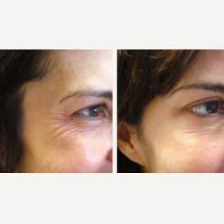 Botox before and after photo