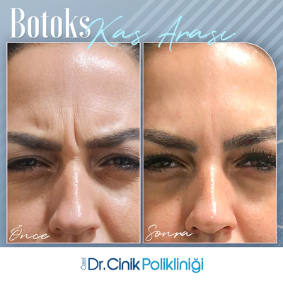 Botox before and after photo