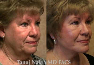 Facelift before and after photo
