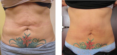 Venus Freeze before and after photo