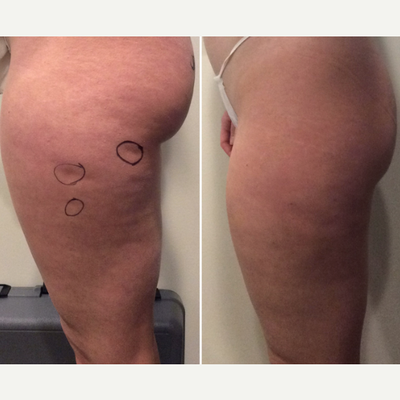 Cellfina before and after photo