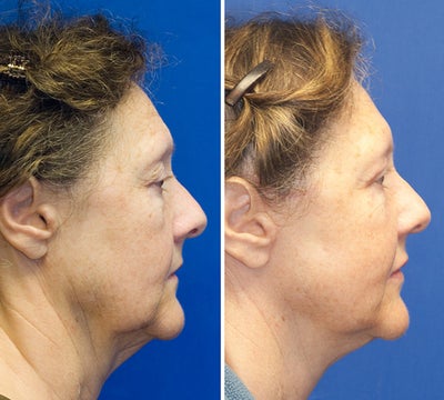 Facelift before and after photo