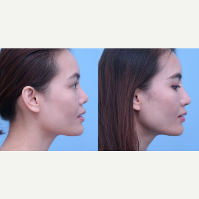 Asian Rhinoplasty before and after photo