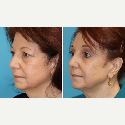 Facelift before and after photo