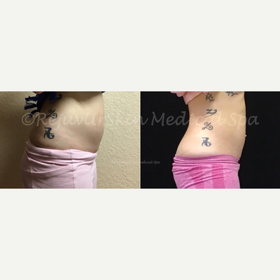 truSculpt before and after photo