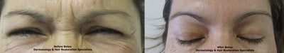 Botox before and after photo