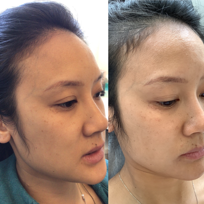 Hair Loss Treatment before and after photo