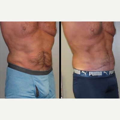 Mini Tummy Tuck before and after photo