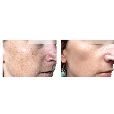 Laser Resurfacing before and after photo