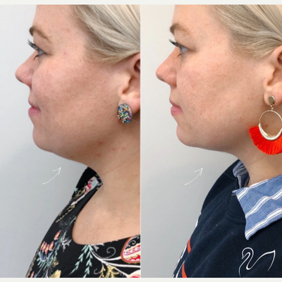 Kybella before and after photo