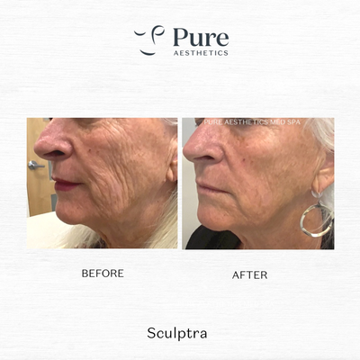 Sculptra before and after photo