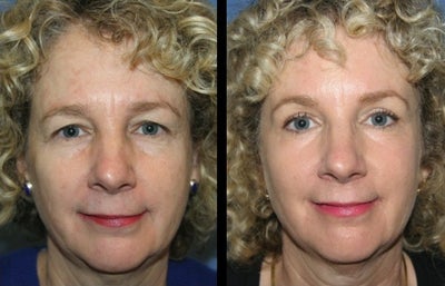 Brow Lift before and after photo