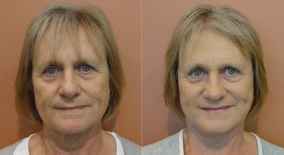 Facelift before and after photo