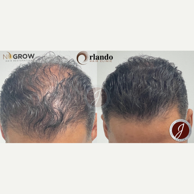 PRP for Hair Loss before and after photo