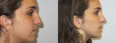 Rhinoplasty before and after photo
