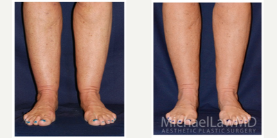 45-54 year old woman treated with Calf Reduction - Lower leg liposcution