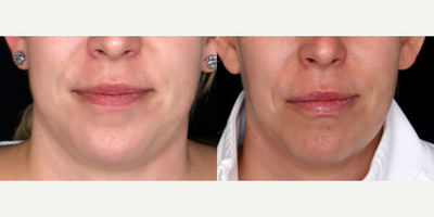39 year old woman treated with Volbella - 39 year old woman treated with Volbella. Photos depict before and 1 month after 1 syringe of Volbella to lips.