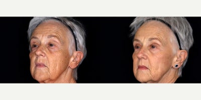72 year old woman treated with 3 syringes of Bellafill to cheeks and under eye - 72 year old woman treated with 3 syringes of Bellafill to cheeks and under eye. Photos depict before and 3 months after treatment.