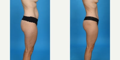 35-44 year old woman treated with Abdominal Etching, Diastasis Recti Repair, Drainless Tummy Tuck, Liposculpture, Liposuction, M - Standard tummy tuck with VASER ultrasound liposuction 360 and corset muscle plication.