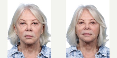 Woman treated with Skin Tightening with XERF - Woman treated with Skin Tightening with XERF
