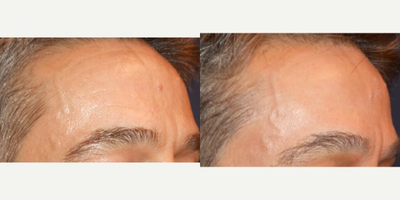 55-64 year old man treated with Fractional CO2 Laser - Patient desired improvement of fine lines. Treated by Dr. Mahlberg with Syneron CO2RE Fractional CO2 laser.