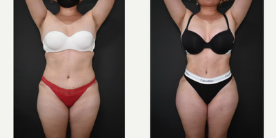 35-44 year old woman treated with Brazilian Butt Lift Revision - This patient had a tummy tuck and BBL 3 years ago, by another PS. She wanted to improve her body contour and also her breast. We performed a Soft Definition Power Assisted Liposuction, BBL and breast augmentation with round, silicone, 410cc, projected Motiva implants.