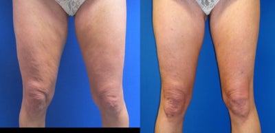 47 year old female treated for thigh skin laxity - This is a 47 year old female who underwent ThermiTight to treat thigh skin laxity.  No liposuction performed.